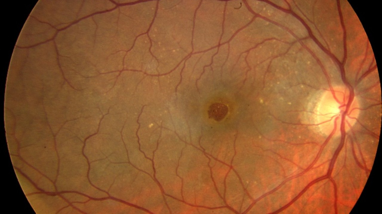 agujero-macular-cirugia-tratamiento-oftalmologico-vision100-monterrey