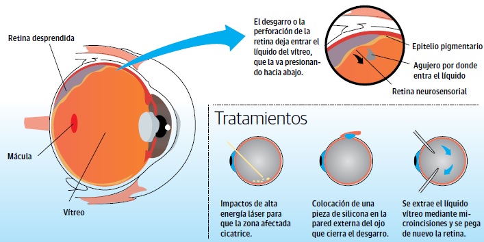 desprendimiento-de-retina-vision100-monterrey-oftalmologos