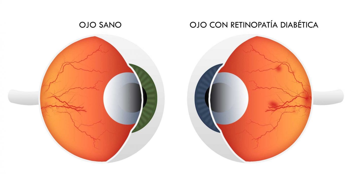 retinopatia-diabetica-ojo-vision100-monterrey